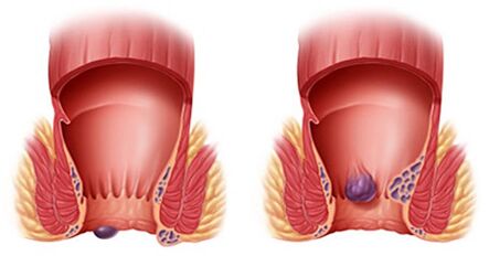 Proctonic helps treat all types of hemorrhoids